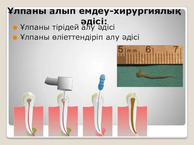 Ұлпаны алып емдеу-хирургиялық әдісі: Ұлпаны тірідей алу әдісі Ұлпаны өліеттендіріп алу әдісі