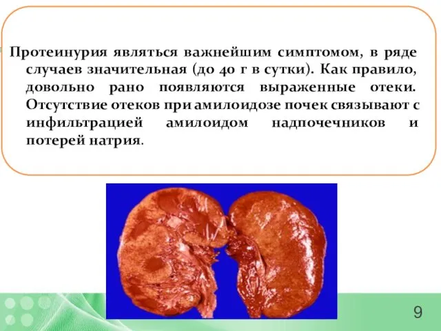 Протеинурия являться важнейшим симптомом, в ряде случаев значительная (до 40