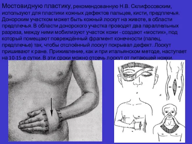 Мостовидную пластику, рекомендованную Н.В. Склифосовским, используют для пластики кожных дефектов пальцев, кисти, предплечья.