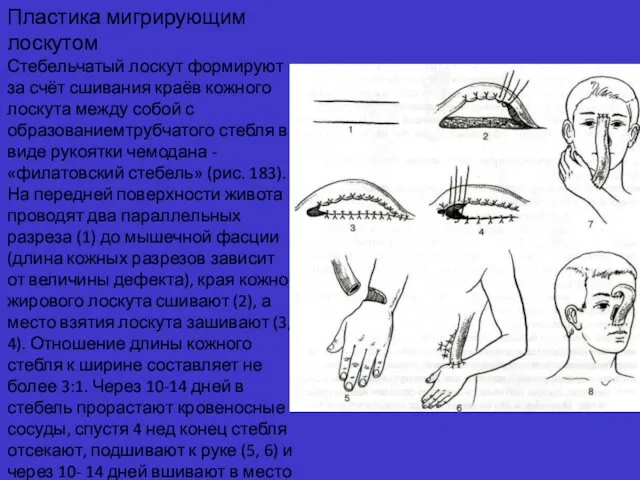 Пластика мигрирующим лоскутом Стебельчатый лоскут формируют за счёт сшивания краёв кожного лоскута между