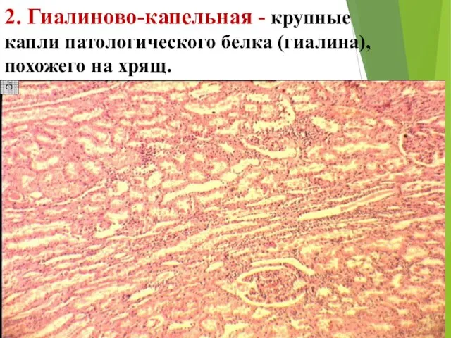 2. Гиалиново-капельная - крупные капли патологического белка (гиалина), похожего на хрящ.