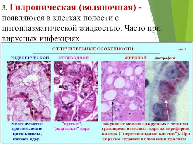 3. Гидропическая (водяночная) - появляются в клетках полости с цитоплазматической жидкостью. Часто при вирусных инфекциях