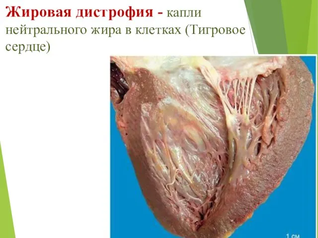 Жировая дистрофия - капли нейтрального жира в клетках (Тигровое сердце)