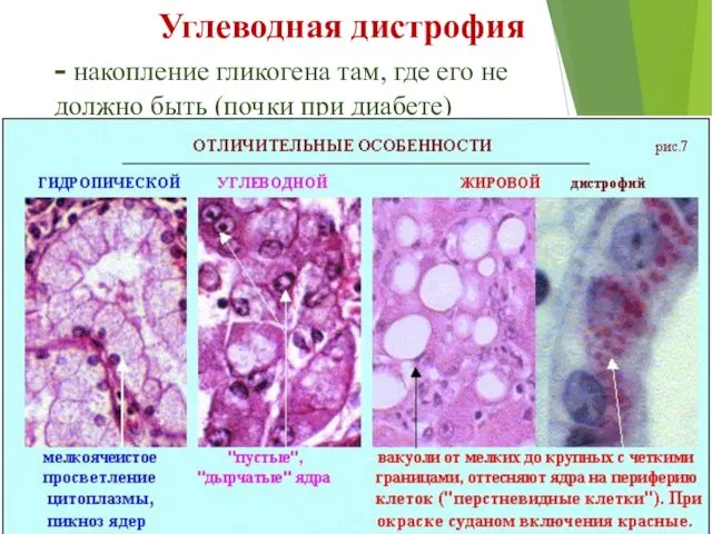 Углеводная дистрофия - накопление гликогена там, где его не должно быть (почки при диабете)