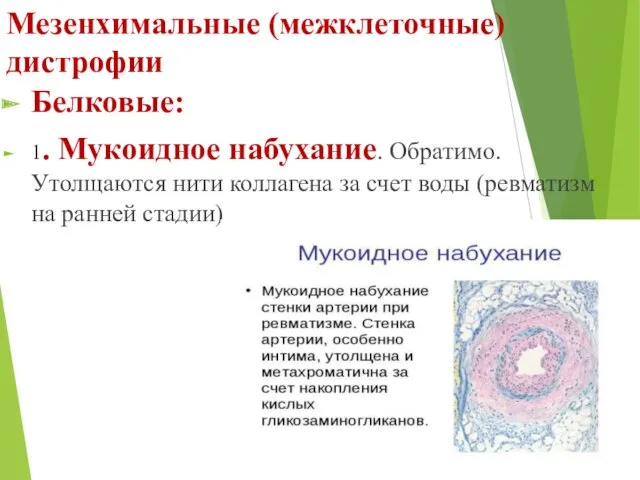 Мезенхимальные (межклеточные) дистрофии Белковые: 1. Мукоидное набухание. Обратимо. Утолщаются нити