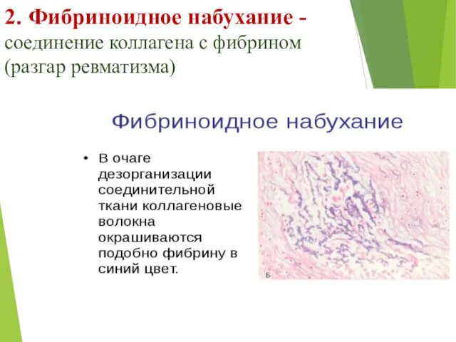 2. Фибриноидное набухание - соединение коллагена с фибрином (разгар ревматизма)