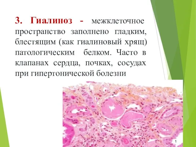 3. Гиалиноз - межклеточное пространство заполнено гладким, блестящим (как гиалиновый