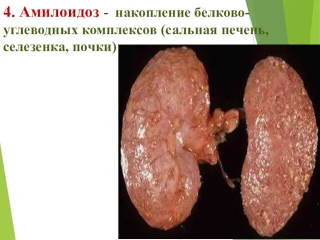 4. Амилоидоз - накопление белково-углеводных комплексов (сальная печень, селезенка, почки)