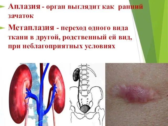 Аплазия - орган выглядит как ранний зачаток Метаплазия - переход