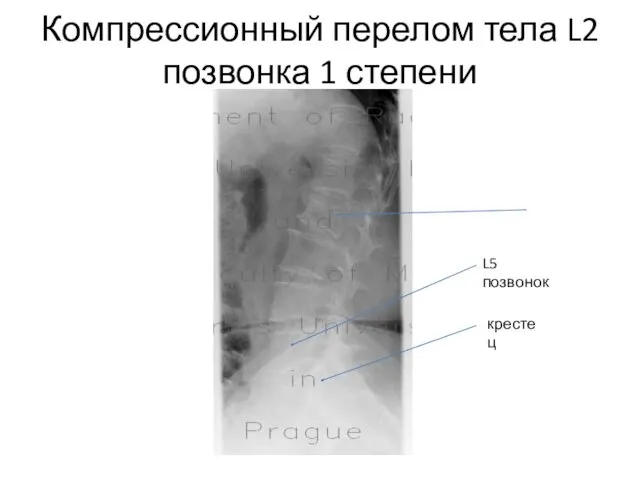 Компрессионный перелом тела L2 позвонка 1 степени крестец L5 позвонок