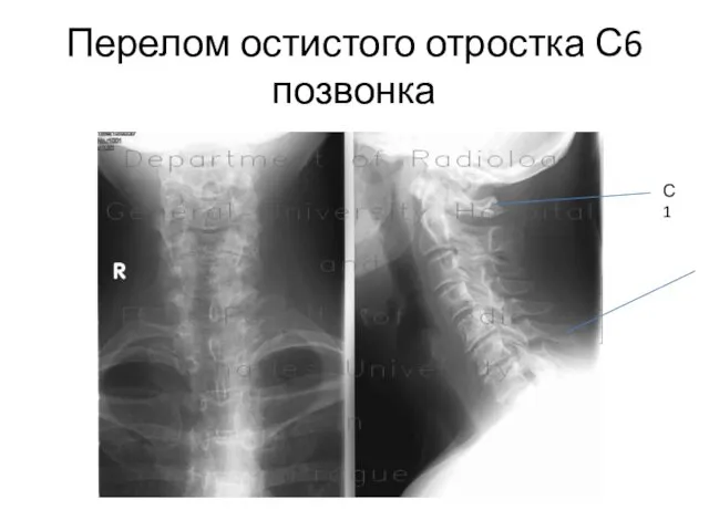 Перелом остистого отростка С6 позвонка С1