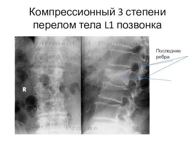 Компрессионный 3 степени перелом тела L1 позвонка Последние ребра