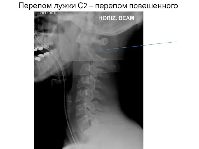 Перелом дужки С2 – перелом повешенного