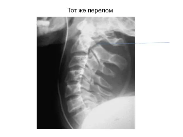 Тот же перелом