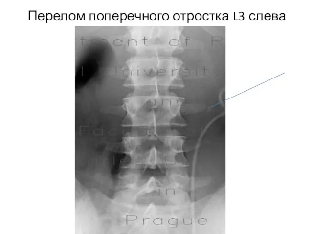 Перелом поперечного отростка L3 слева