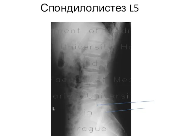 Спондилолистез L5