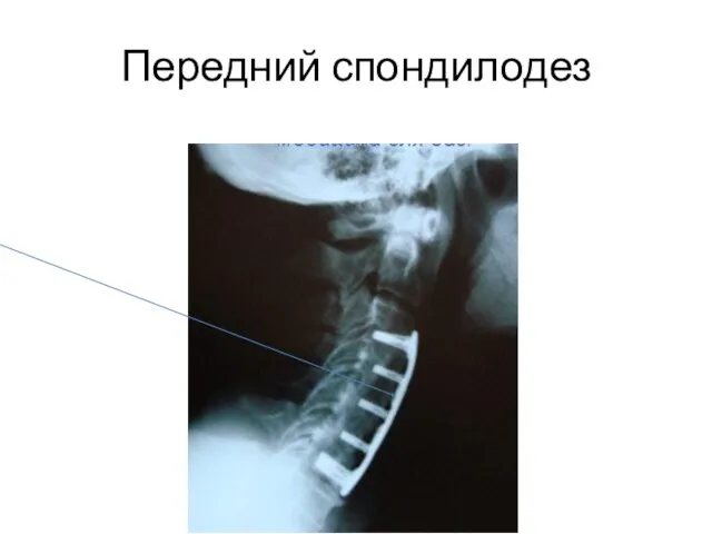 Передний спондилодез