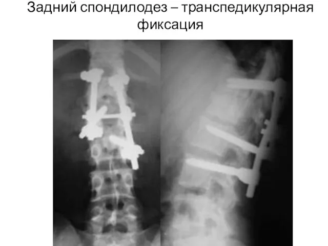 Задний спондилодез – транспедикулярная фиксация