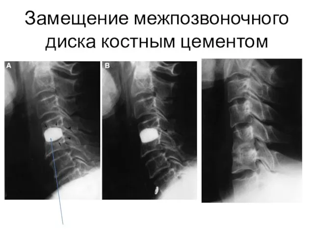 Замещение межпозвоночного диска костным цементом