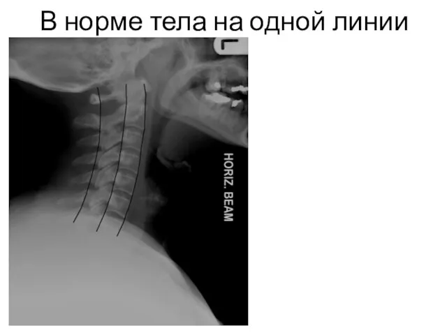 В норме тела на одной линии