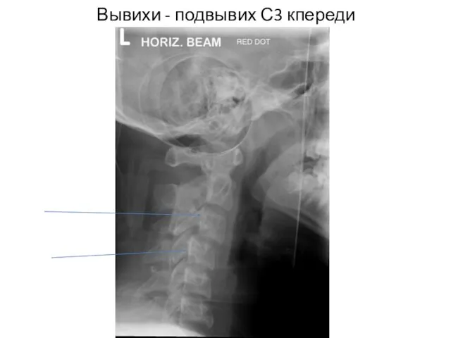 Вывихи - подвывих С3 кпереди