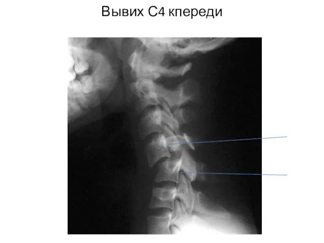 Вывих С4 кпереди