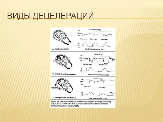 ВИДЫ ДЕЦЕЛЕРАЦИЙ