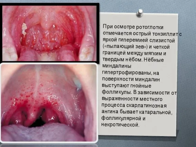 При осмотре ротоглотки отмечается острый тонзиллит с яркой гиперемией слизистой