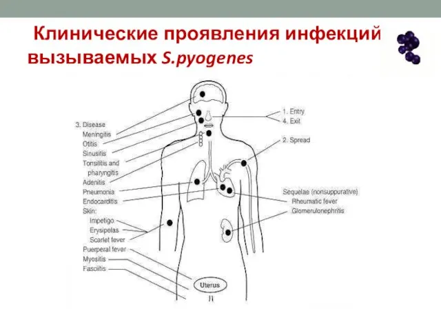 Клинические проявления инфекций, вызываемых S.pyogenes