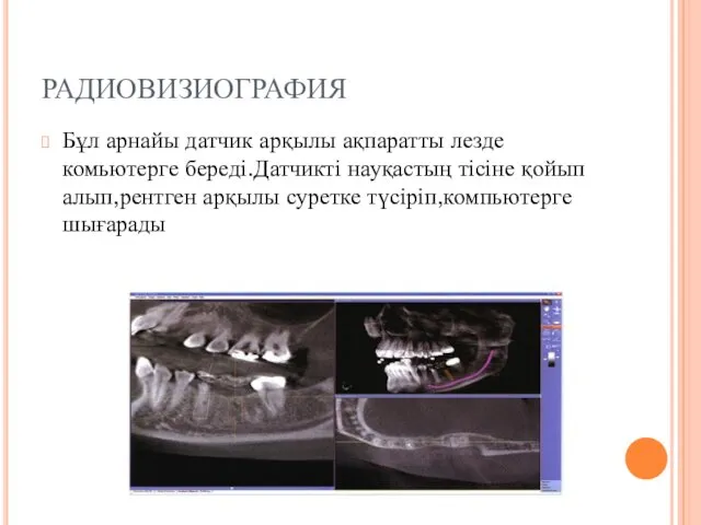 РАДИОВИЗИОГРАФИЯ Бұл арнайы датчик арқылы ақпаратты лезде комьютерге береді.Датчикті науқастың