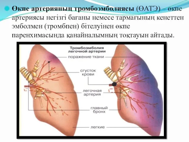 Өкпе артерияның тромбоэмболиясы (ӨАТЭ) – өкпе артериясы негізгі бағаны немесе