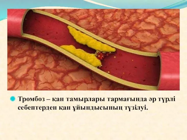 Тромбоз – қан тамырлары тармағында әр түрлі себептерден қан ұйындысының түзілуі.