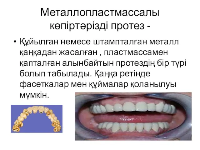 Металлопластмассалы көпіртәрізді протез - Құйылған немесе штампталған металл қаңқадан жасалған