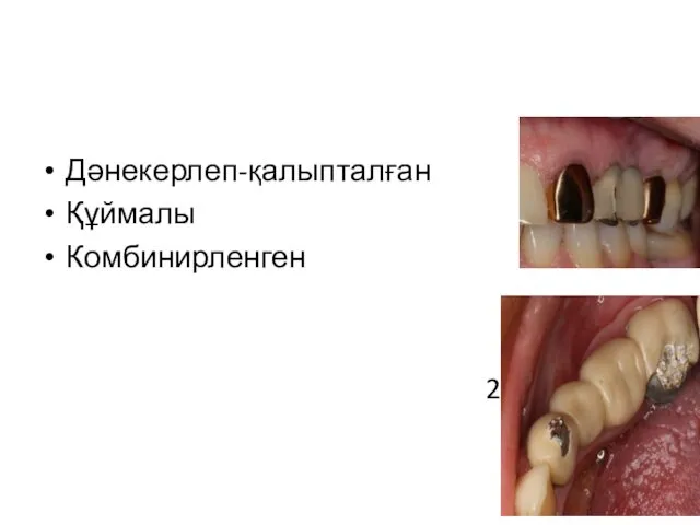 Металлопластмассалы көпіртәрізді протездің қаңқасының ерекшеліктеріне байланысты түрлері 1) Дәнекерлеп-қалыпталған Құймалы Комбинирленген 2)