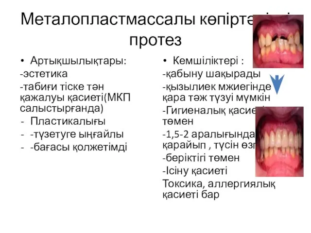 Металопластмассалы көпіртәрізді протез Артықшылықтары: -эстетика -табиғи тіске тән қажалуы қасиеті(МКП