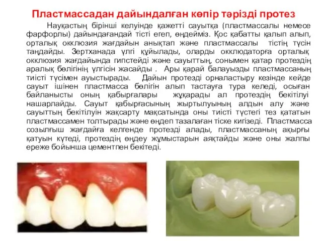 Пластмассадан дайындалған көпір тәрізді протез Науқастың бірінші келуінде қажетті сауытқа