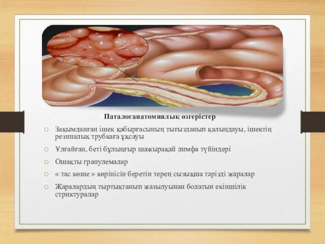 Паталоганатомиялық өзгерістер Зақымданған ішек қабырғасының тығызданып қалыңдауы, ішектің резиналық трубкаға