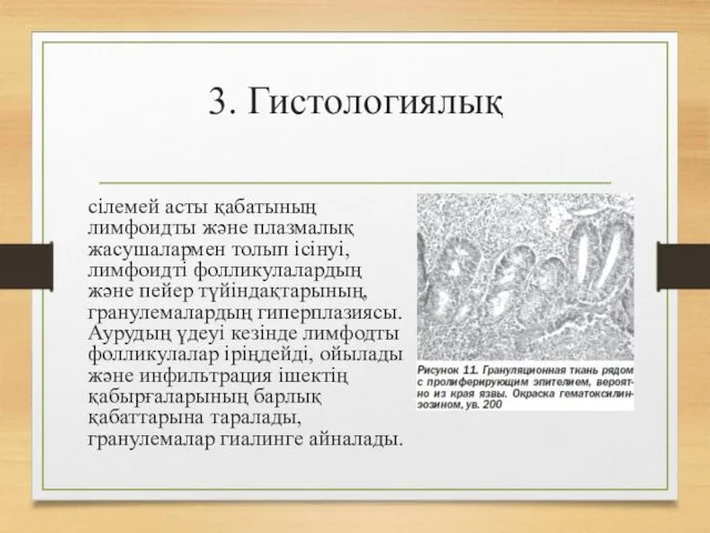 3. Гистологиялық сілемей асты қабатының лимфоидты жəне плазмалық жасушалармен толып