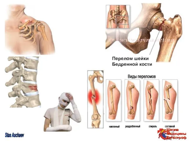 Перелом шейки Бедренной кости Stas Aschaev