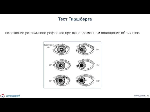 Тест Гиршберга положение роговичного рефлекса при одновременном освещении обоих глаз