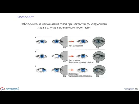 Cover-тест Наблюдение за движениями глаза при закрытии фиксирующего глаза в случае выраженного косоглазия