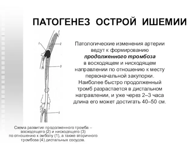 ПАТОГЕНЕЗ ОСТРОЙ ИШЕМИИ Патологические изменения артерии ведут к формированию продолженного