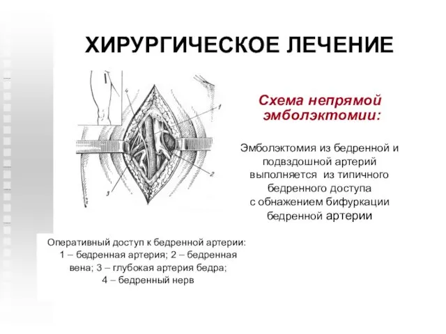 ХИРУРГИЧЕСКОЕ ЛЕЧЕНИЕ Схема непрямой эмболэктомии: Эмболэктомия из бедренной и подвздошной