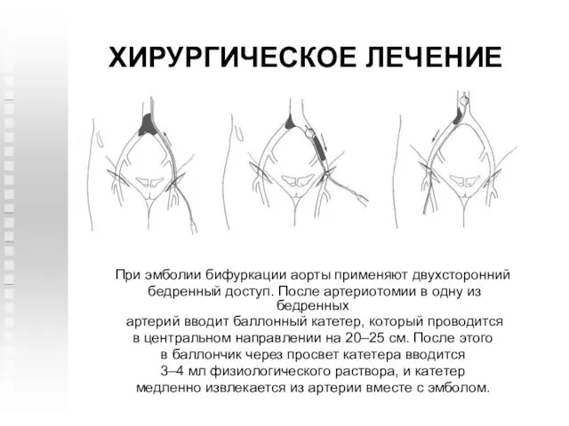 ХИРУРГИЧЕСКОЕ ЛЕЧЕНИЕ При эмболии бифуркации аорты применяют двухсторонний бедренный доступ.