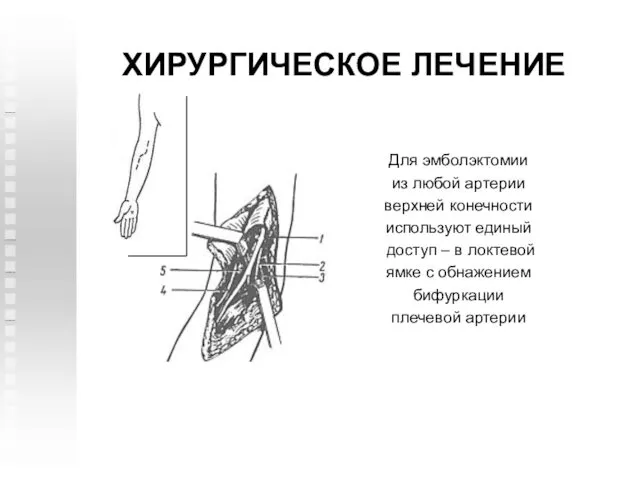 ХИРУРГИЧЕСКОЕ ЛЕЧЕНИЕ Для эмболэктомии из любой артерии верхней конечности используют