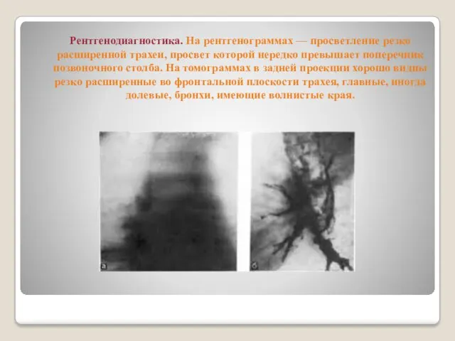 Рентгенодиагностика. На рентгенограммах — просветление резко расширенной трахеи, просвет которой нередко превышает поперечник