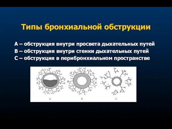 Типы бронхиальной обструкции А – обструкция внутри просвета дыхательных путей