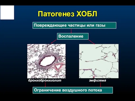 Патогенез ХОБЛ Воспаление Повреждающие частицы или газы Ограничение воздушного потока бронхобронхиолит эмфизема