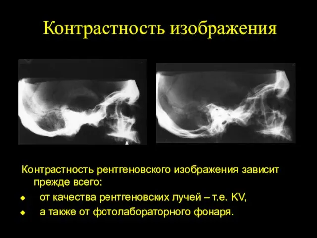 Контрастность изображения Контрастность рентгеновского изображения зависит прежде всего: от качества рентгеновских лучей –