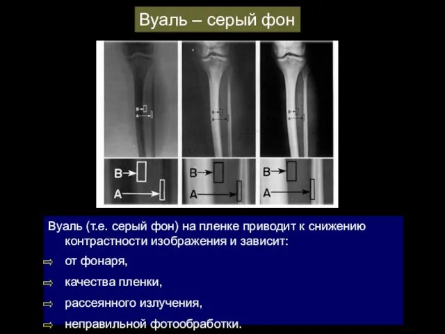 Вуаль (т.е. серый фон) на пленке приводит к снижению контрастности